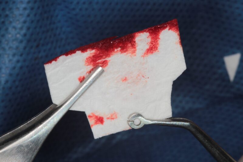 CollaShield Dental Collagen | Surgical Esthetics | Surgical Esthetics Bone Graft