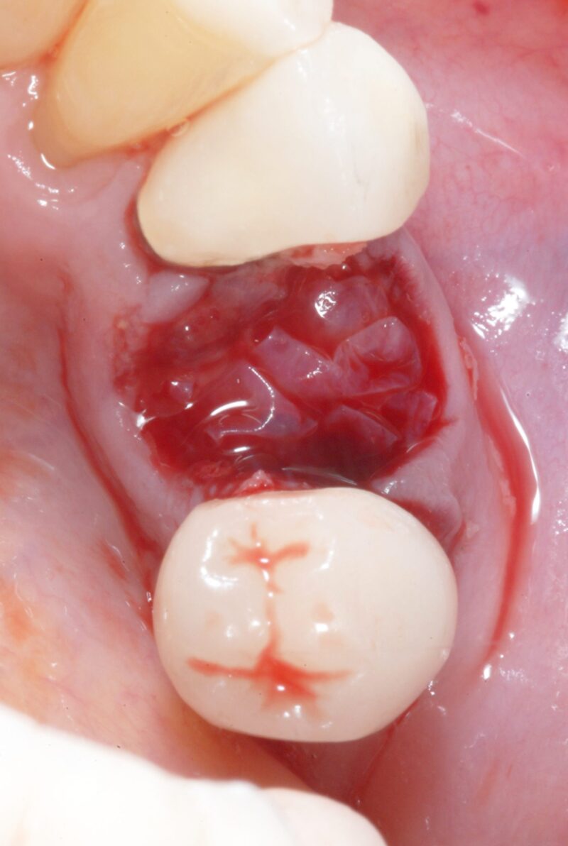 AmnioGain Amnion-Chorion Sheet | Surgical Esthetics | Surgical Esthetics Bone Graft
