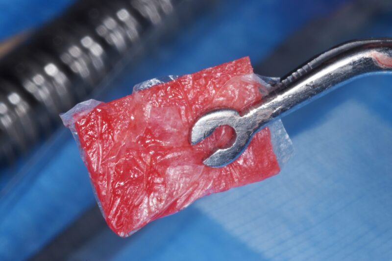 AmnioGain Amnion-Chorion Sheet | Surgical Esthetics | Surgical Esthetics Bone Graft